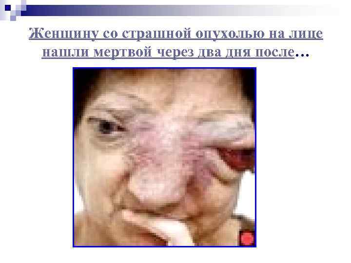 Женщину со страшной опухолью на лице нашли мертвой через два дня после… 