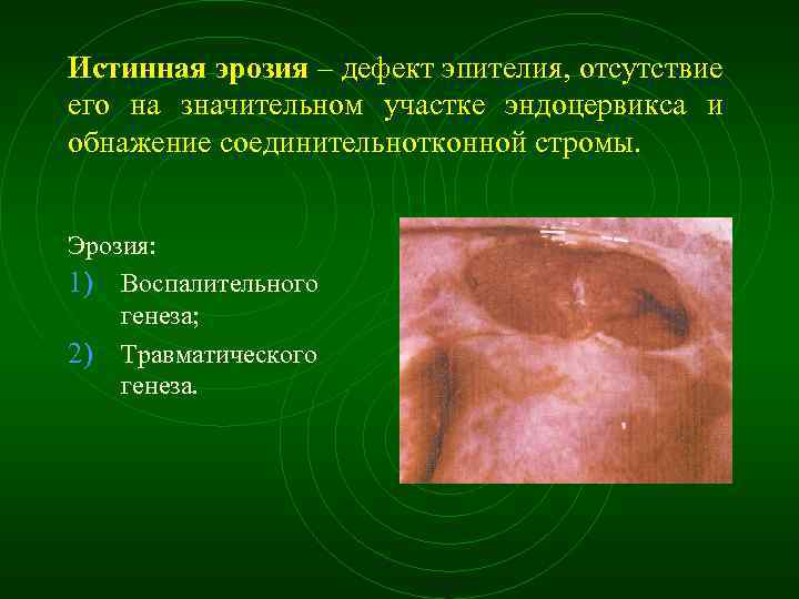 Истинная эрозия – дефект эпителия, отсутствие его на значительном участке эндоцервикса и обнажение соединительнотконной