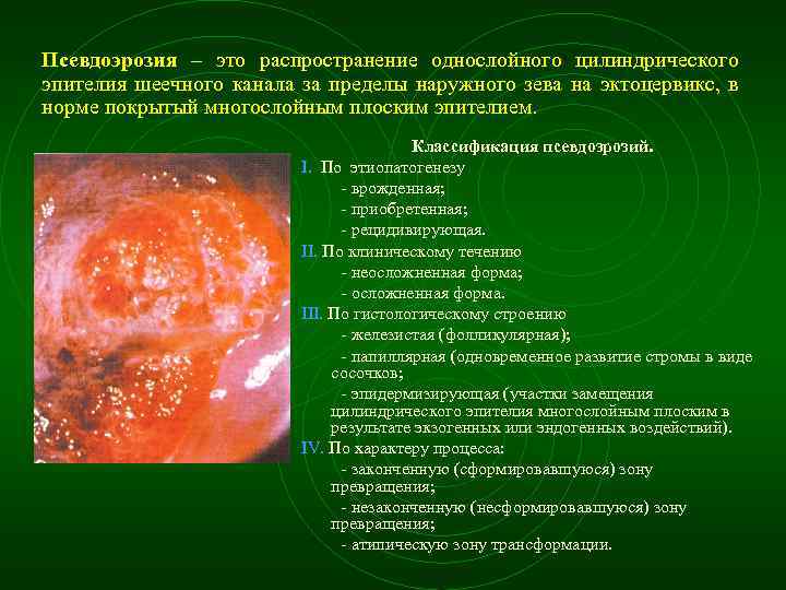 Псевдоэрозия – это распространение однослойного цилиндрического эпителия шеечного канала за пределы наружного зева на