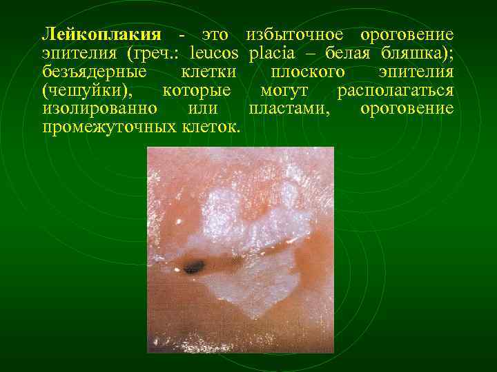 Лейкоплакия это избыточное ороговение эпителия (греч. : leucos placia – белая бляшка); безъядерные клетки