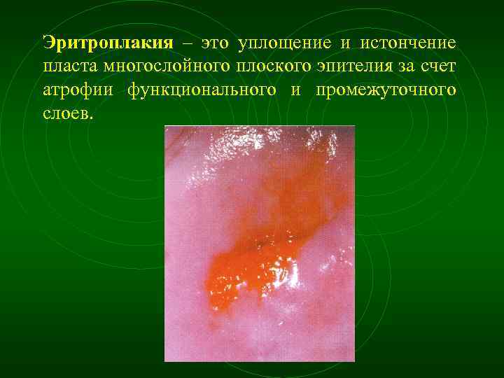 Эритроплакия – это уплощение и истончение пласта многослойного плоского эпителия за счет атрофии функционального