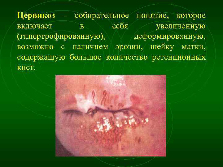 Цервикоз – собирательное понятие, которое включает в себя увеличенную (гипертрофированную), деформированную, возможно с наличием