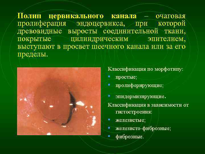 Полип цервикального канала – очаговая пролиферация эндоцервикса, при которой древовидные выросты соединительной ткани, покрытые