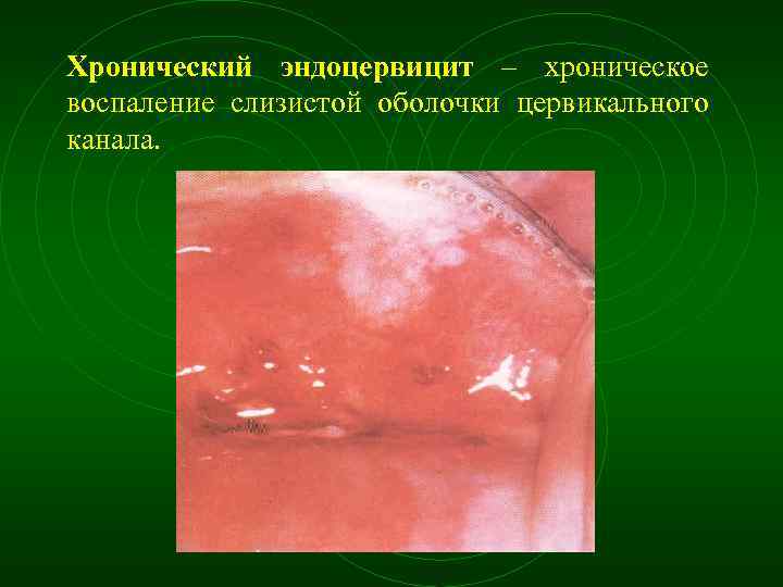 Хронический эндоцервицит – хроническое воспаление слизистой оболочки цервикального канала. 