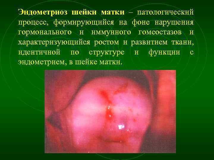 Эндометриоз шейки матки – патологический процесс, формирующийся на фоне нарушения гормонального и иммунного гомеостазов