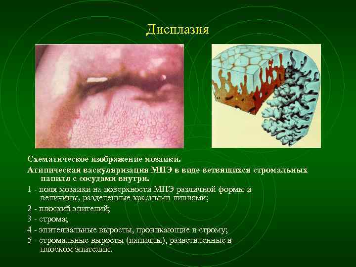 Дисплазия Схематическое изображение мозаики. Атипическая васкуляризация МПЭ в виде ветвящихся стромальных папилл с сосудами