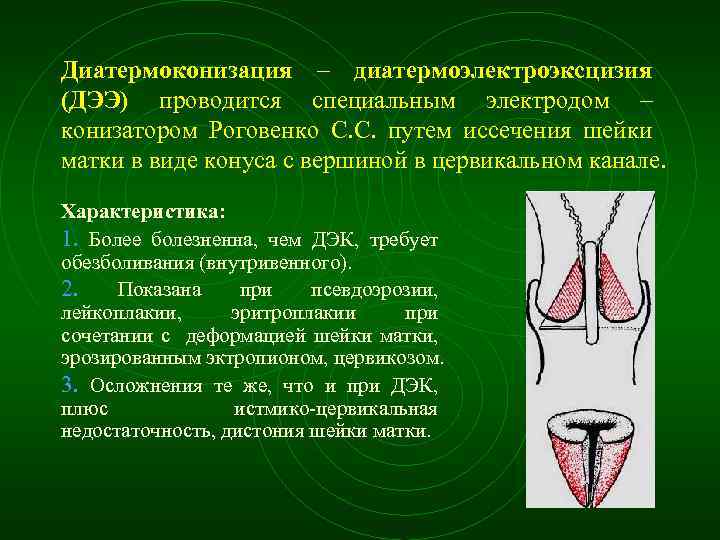 Диатермоконизация – диатермоэлектроэксцизия (ДЭЭ) проводится специальным электродом – конизатором Роговенко С. С. путем иссечения