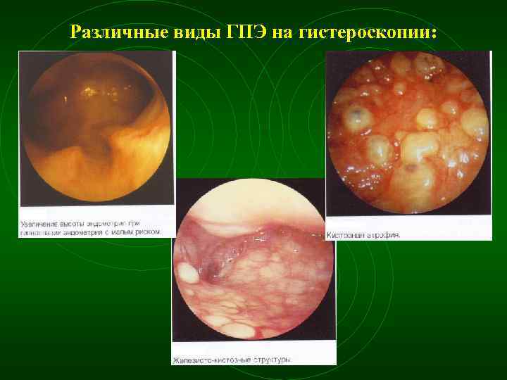 Различные виды ГПЭ на гистероскопии: 
