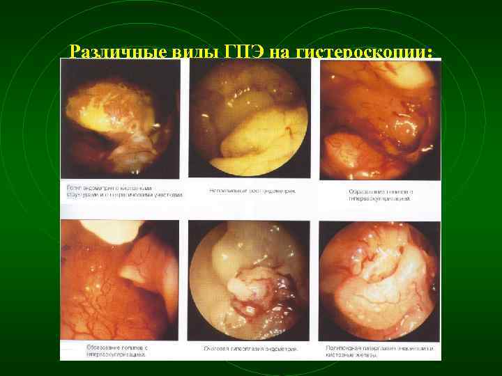 Различные виды ГПЭ на гистероскопии: 