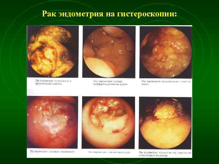 Рак эндометрия на гистероскопии: 