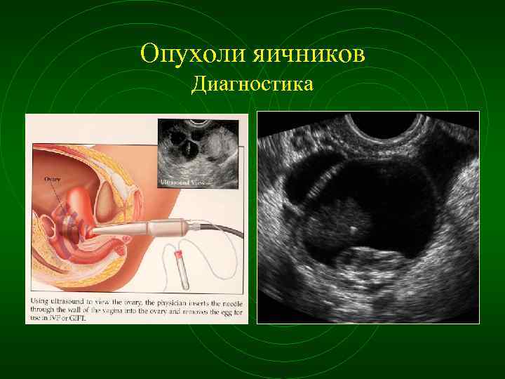Опухоли яичников Диагностика 