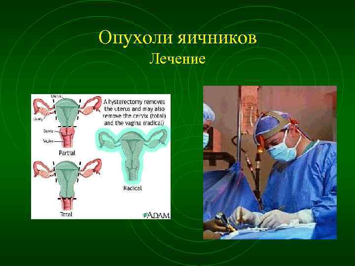 Опухоли яичников Лечение 