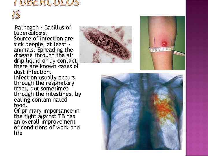 Pathogen - Bacillus of tuberculosis. Source of infection are sick people, at least animals.