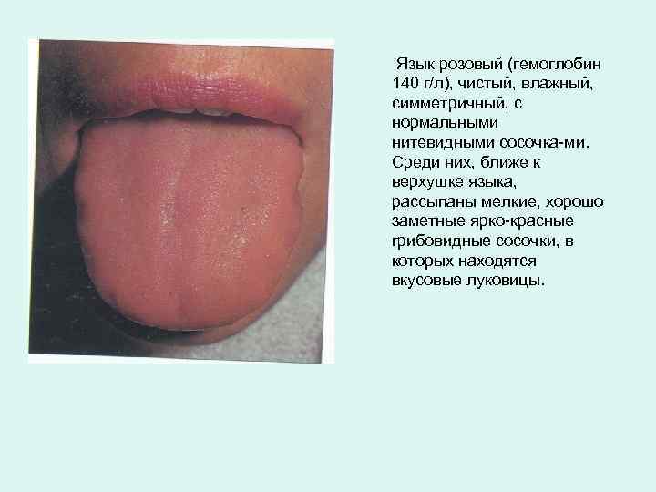Язык розовый (гемоглобин 140 г/л), чистый, влажный, симметричный, с нормальными нитевидными сосочка ми. Среди