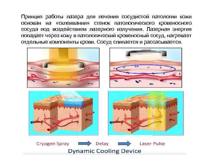 Принцип работы лазера для лечения сосудистой патологии кожи основан на «склеивании» стенок патологического кровеносного