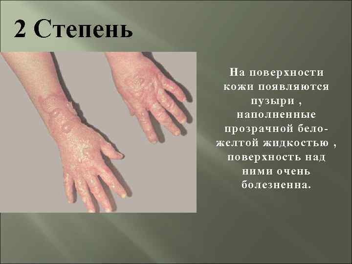 2 Степень На поверхности кожи появляются пузыри , наполненные прозрачной беложелтой жидкостью , поверхность
