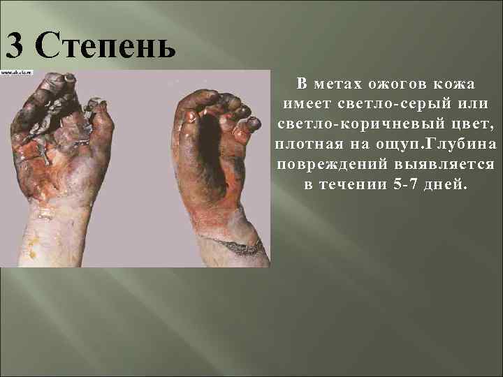 3 Степень В метах ожогов кожа имеет светло-серый или светло-коричневый цвет, плотная на ощуп.