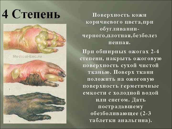 4 Степень Поверхность кожи коричневого цвета, при обугливаниичерного, плотная, безболез ненная. При обширных ожогах