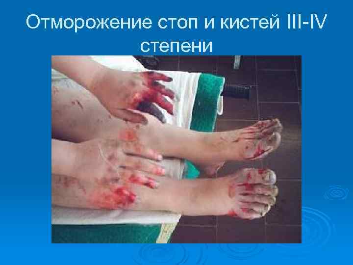 Отморожение стоп и кистей III-IV степени 