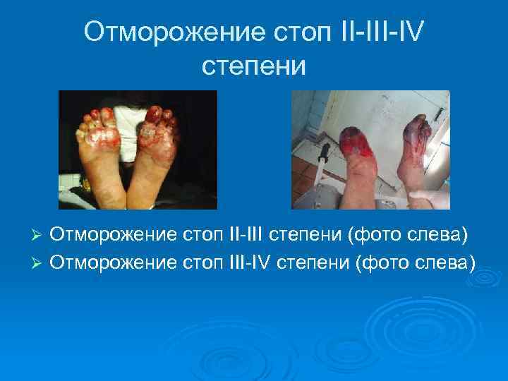 Отморожение стоп II-IV степени Отморожение стоп II-III степени (фото слева) Ø Отморожение стоп III-IV