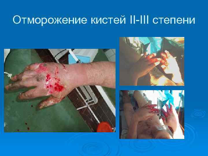Отморожение кистей II-III степени 