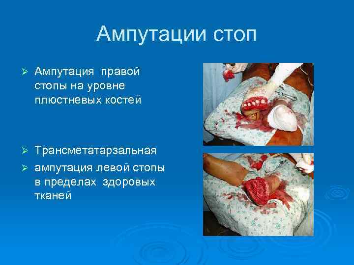 Ампутации стоп Ø Ампутация правой стопы на уровне плюстневых костей Трансметатарзальная Ø ампутация левой