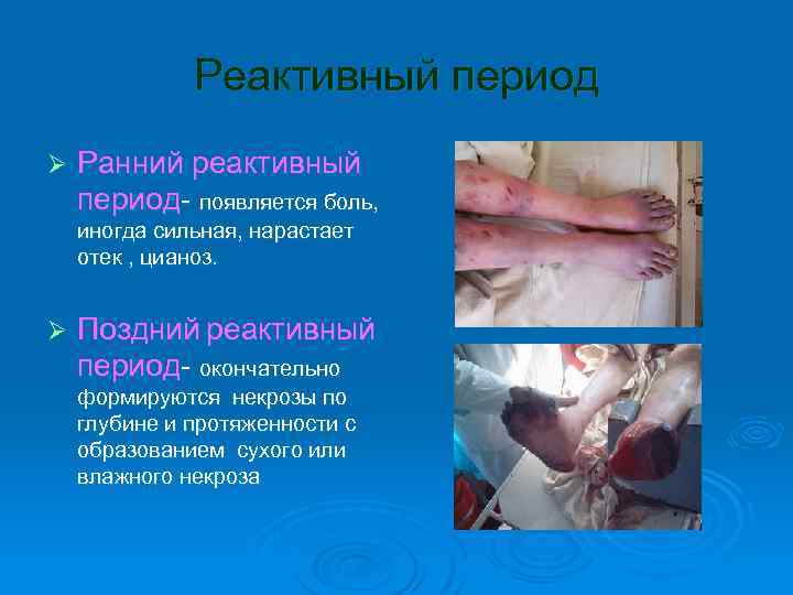 Реактивный период Ø Ранний реактивный период- появляется боль, иногда сильная, нарастает отек , цианоз.