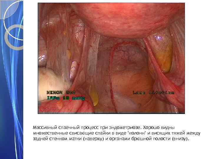 Массивный спаечный процесс при эндометриозе. Хорошо видны множественные свисающие спайки в виде "колонн" и
