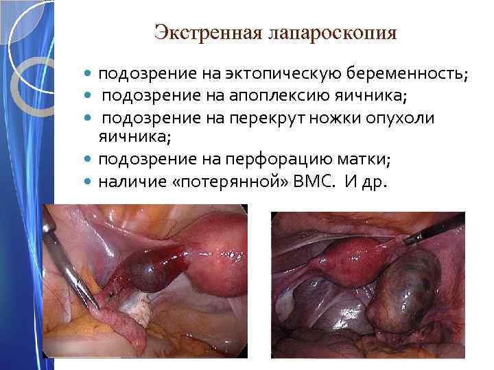Экстренная лапароскопия подозрение на эктопическую беременность; подозрение на апоплексию яичника; подозрение на перекрут ножки