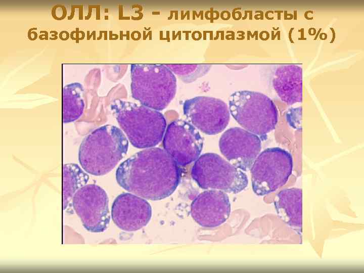 ОЛЛ: L 3 - лимфобласты с базофильной цитоплазмой (1%) 
