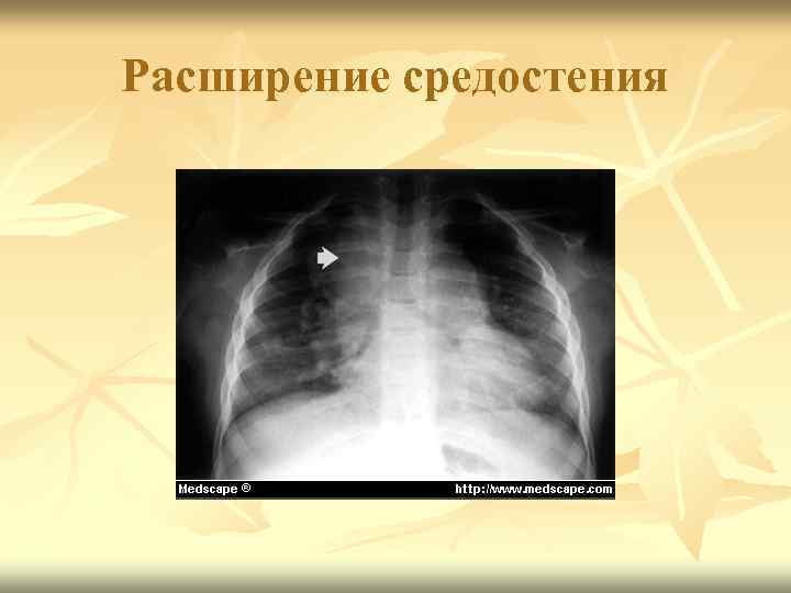 Расширение средостения 