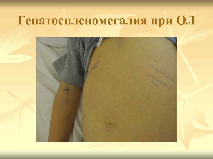 Гепатоспленомегалия при ОЛ 
