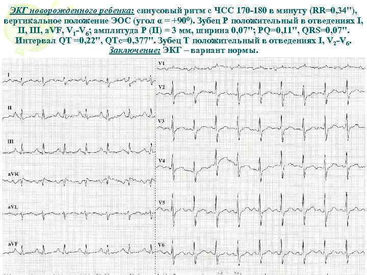 ЭКГ новорожденного ребенка: синусовый ритм с ЧСС 170 -180 в минуту (RR=0, 34''), вертикальное