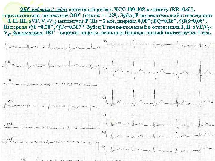 Синусовый ритм с чсс. Кардиограмма сердца заключение синусовый ритм. Ритм синусовый ЧСС 108. ЭКГ норма ритм ЧСС. ЭКГ синусовый ритм ЧСС 75 уд в мин/ горизонтальное положение ЭОС.