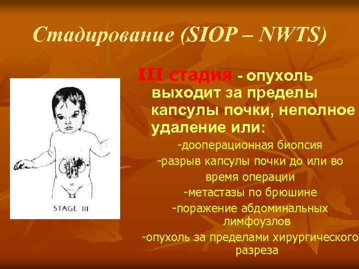 Стадирование (SIOP – NWTS) III стадия - опухоль выходит за пределы капсулы почки, неполное