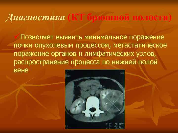 Диагностика (КТ брюшной полости) üПозволяет выявить минимальное поражение почки опухолевым процессом, метастатическое поражение органов