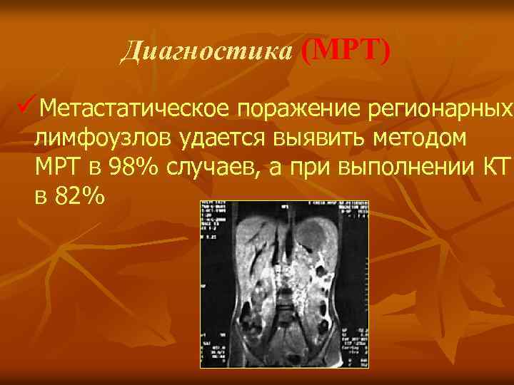 Диагностика (МРТ) üМетастатическое поражение регионарных лимфоузлов удается выявить методом МРТ в 98% случаев, а