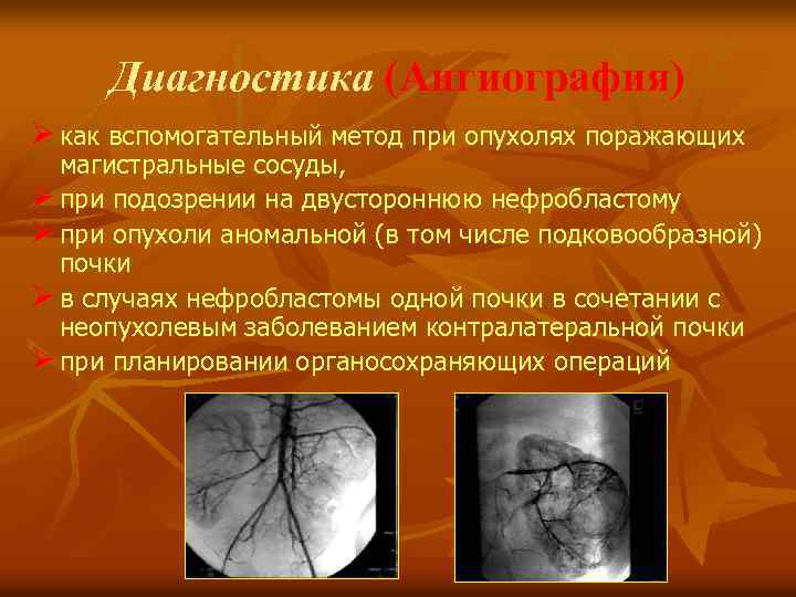 Диагностика (Ангиография) Ø как вспомогательный метод при опухолях поражающих магистральные сосуды, Ø при подозрении
