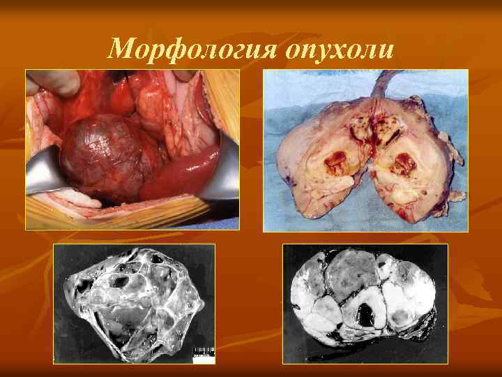 Морфология опухоли 
