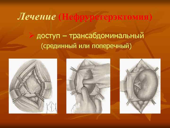 Лечение (Нефруретерэктомия) Ø доступ – трансабдоминальный (срединный или поперечный) 