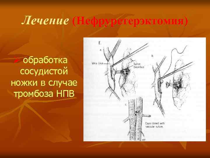 Лечение (Нефруретерэктомия) Ø обработка сосудистой ножки в случае тромбоза НПВ 