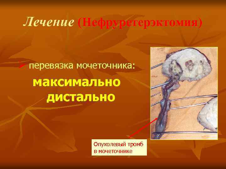 Лечение (Нефруретерэктомия) Ø перевязка мочеточника: максимально дистально Опухолевый тромб в мочеточнике 