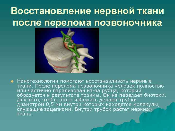 Восстановление нервной ткани после перелома позвоночника u Нанотехнологии помогают восстанавливать нервные ткани. После перелома