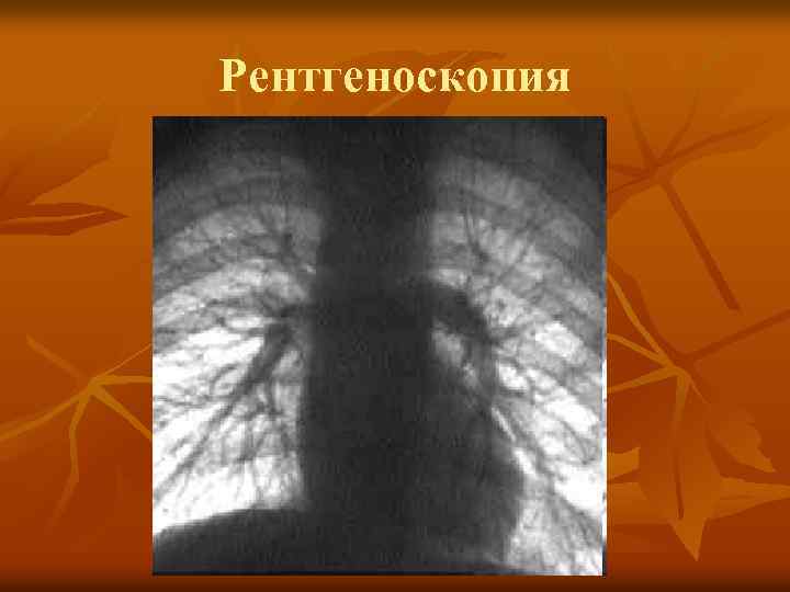 Рентгеноскопия 