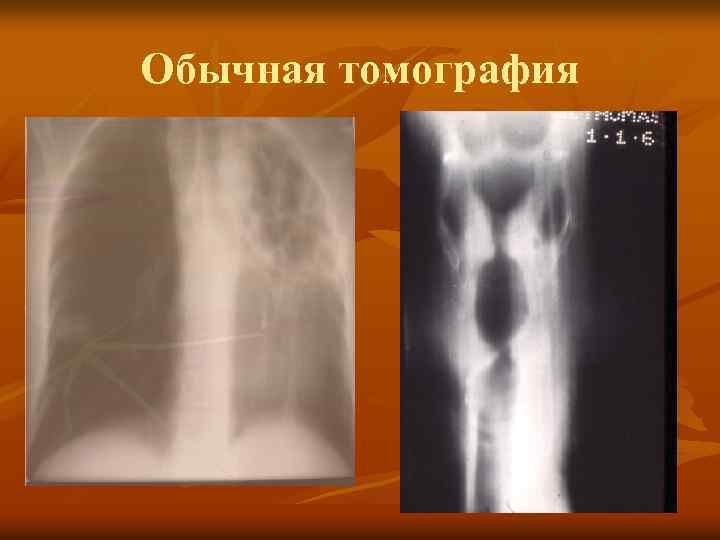 Обычная томография 