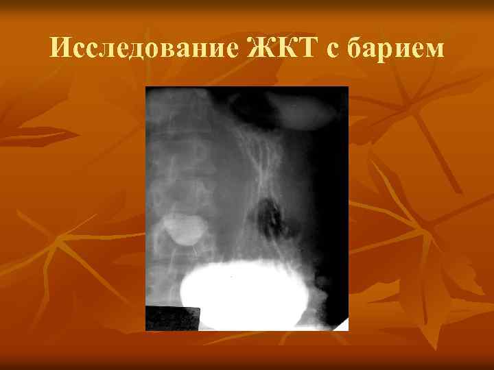 Исследование ЖКТ с барием 