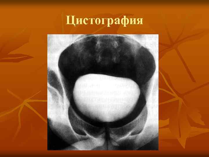 Цистография 