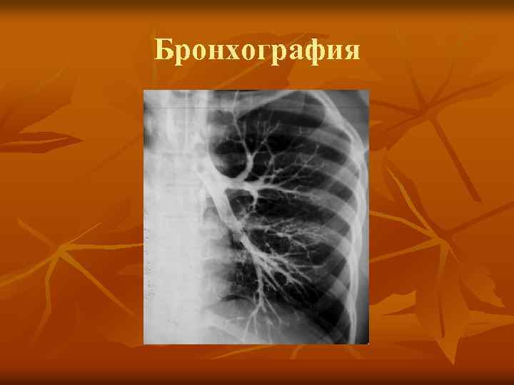 Бронхография 