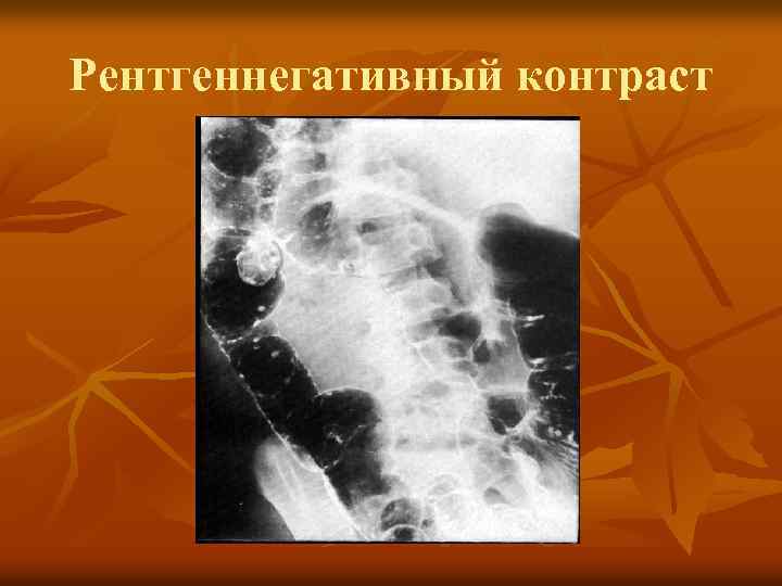 Рентгеннегативный контраст 
