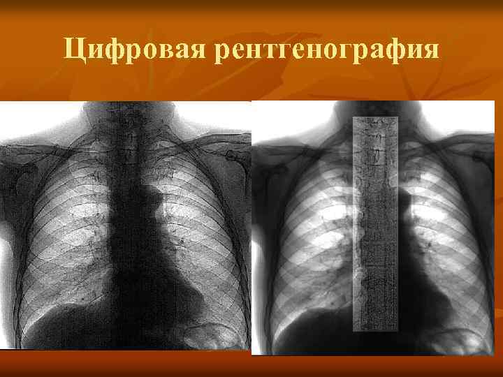 Цифровая рентгенография 